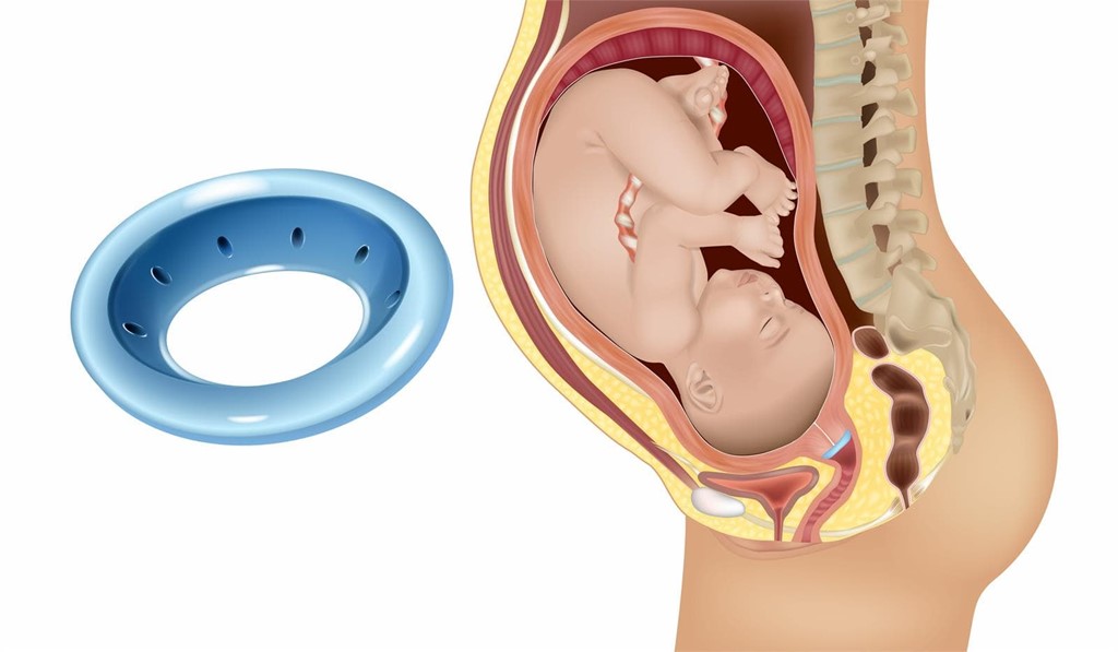 Pesario de Arabin para amenaza de parto prematuro 