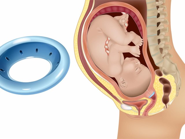 Pesario de Arabin para amenaza de parto prematuro 